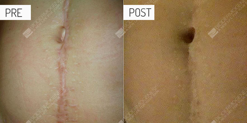 Cicatrices: fotos de antes y después