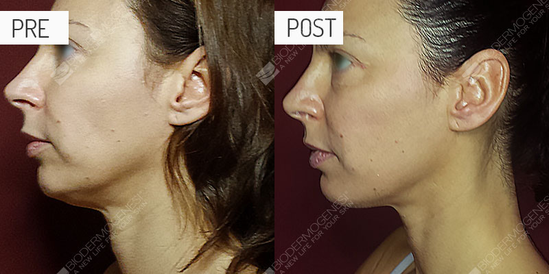 Rejuvenecimiento facial: fotos de antes y después