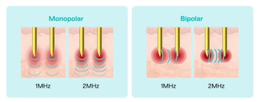 Grafico potenza monopolar bipolar