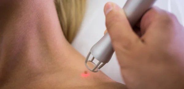 primer-plano-laser-piel-invertir-laser-picosegundos