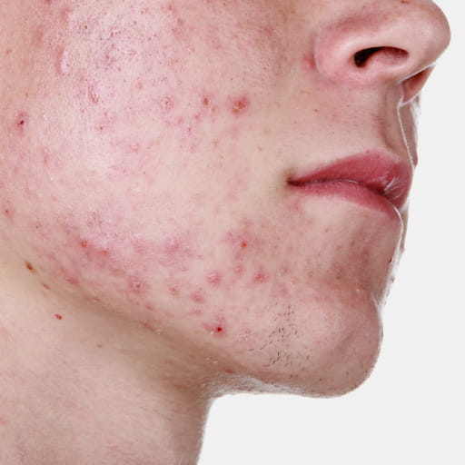 equipo para el tratamiento del acne
