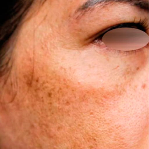 equipos tratamiento melasma