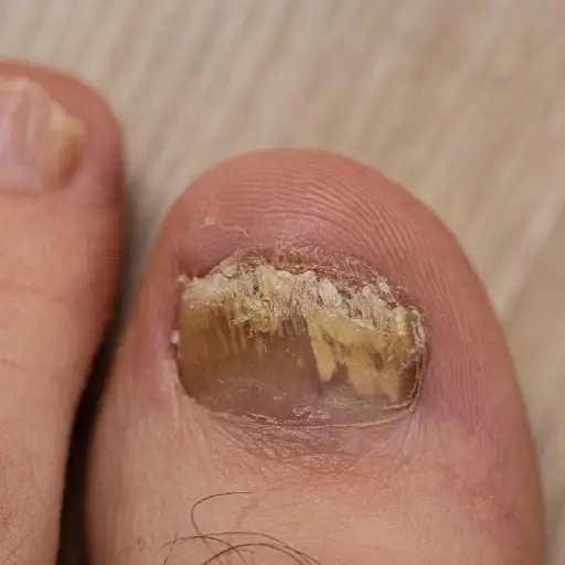 Onicomicosis